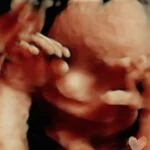 HD_Ultrasound_20 HD_Ultrasound_20