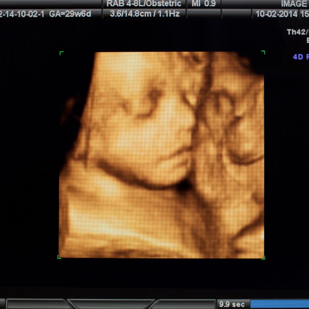  3D ultrasound
